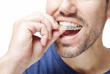 Invisalign Invisible Aligners